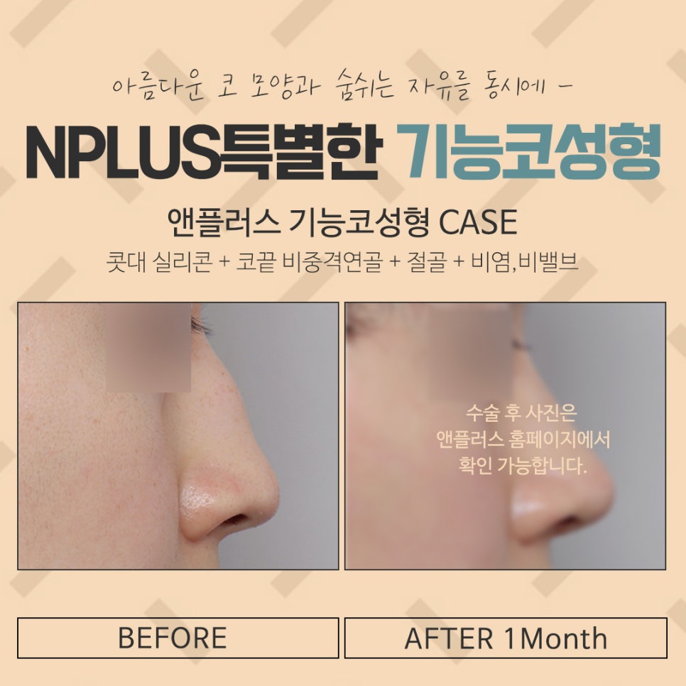 Understanding and Preparing for Functional Rhinoplasty Coverage in Detail image 13