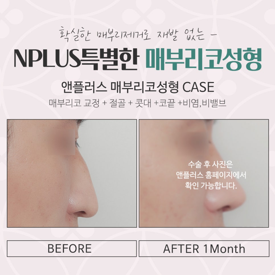매부리코성형후기 다양한 내용을 찾아보고 관련 이미지 16