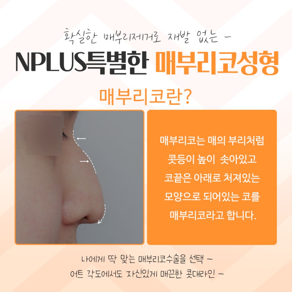 매부리코성형후기를 자세하게 알아보고 관련 이미지 3