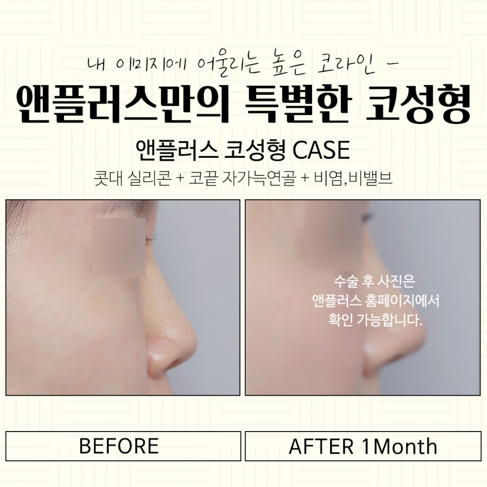 Autologous Cartilage Rhinoplasty for a Natural Nose Line image 15