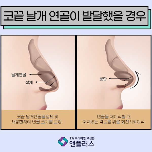 화살코성형 코끝이 고민일때 관련 이미지 5