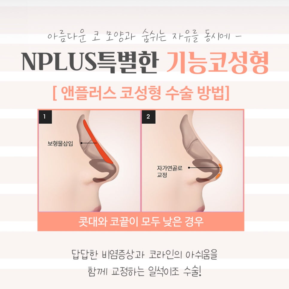 기능코성형후기에 대해 상세히 알아보고 관련 이미지 10