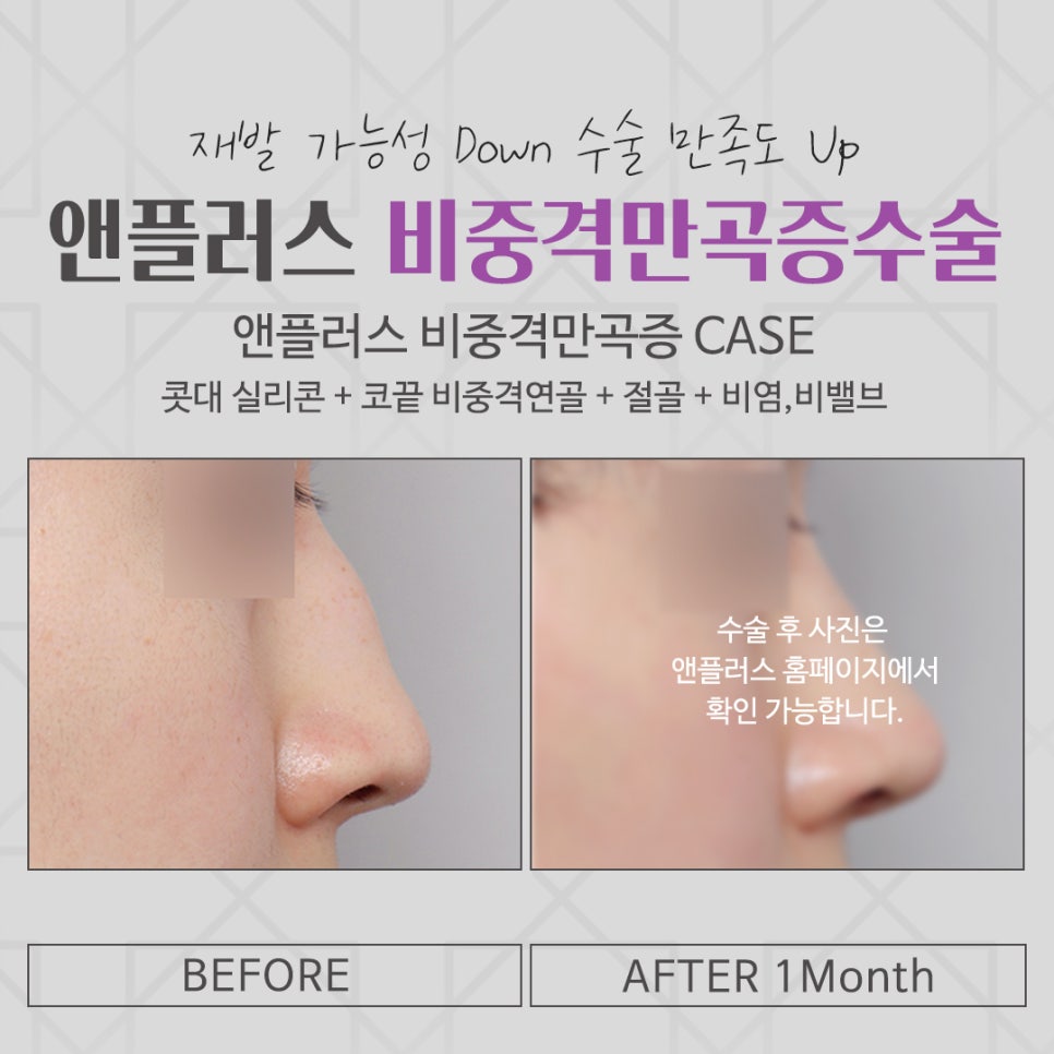 비중격만곡증수술 원인을 자세하게 관련 이미지 15
