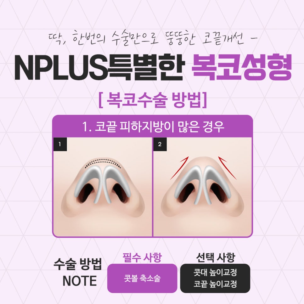 복코수술후기에 대해 세세하게 알아보고 관련 이미지 8