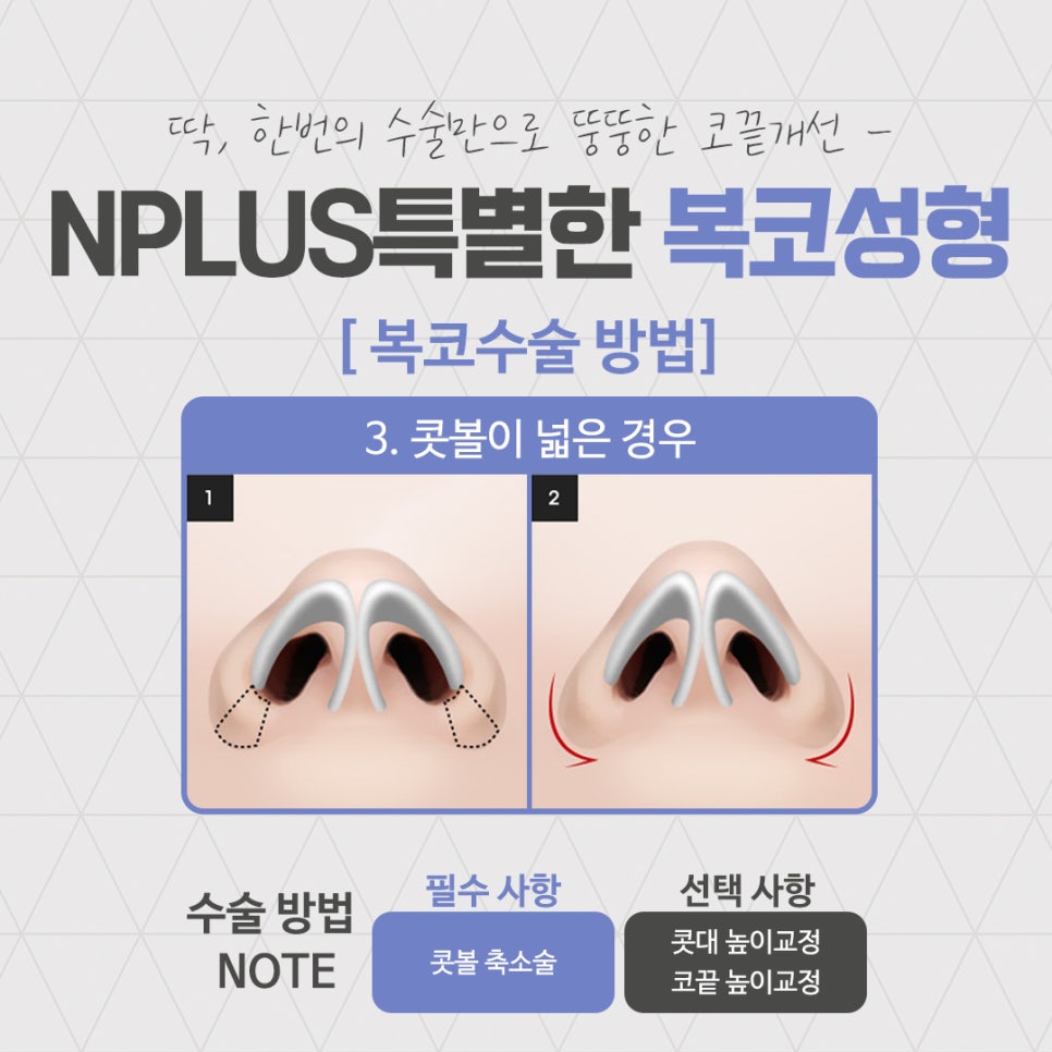 복코성형후기로 알아보는 코지방제거 관련 이미지 8