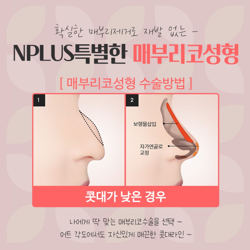 매부리코수술후기 자세하게 알아봐야 관련 이미지 10