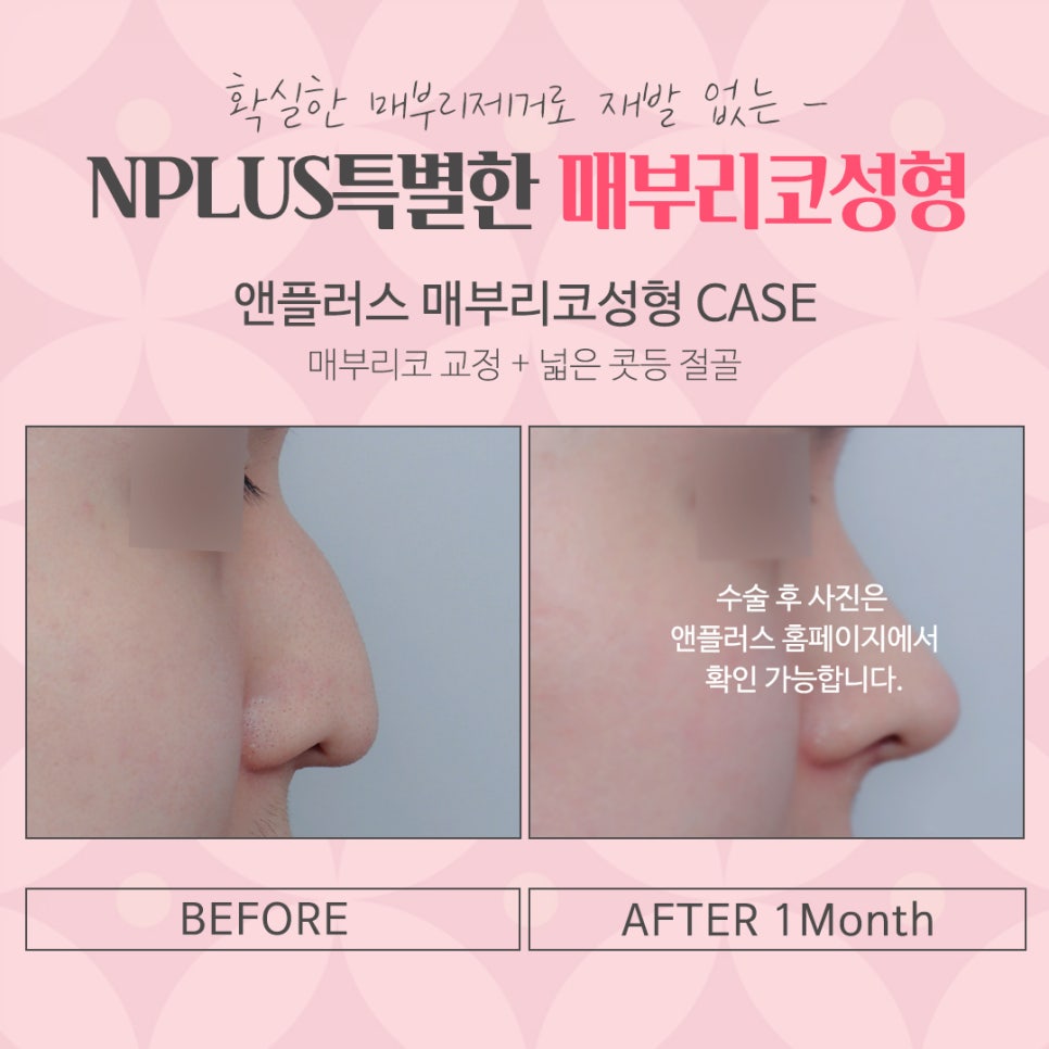 매부리코성형후기 내부까지 확인하고 관련 이미지 15