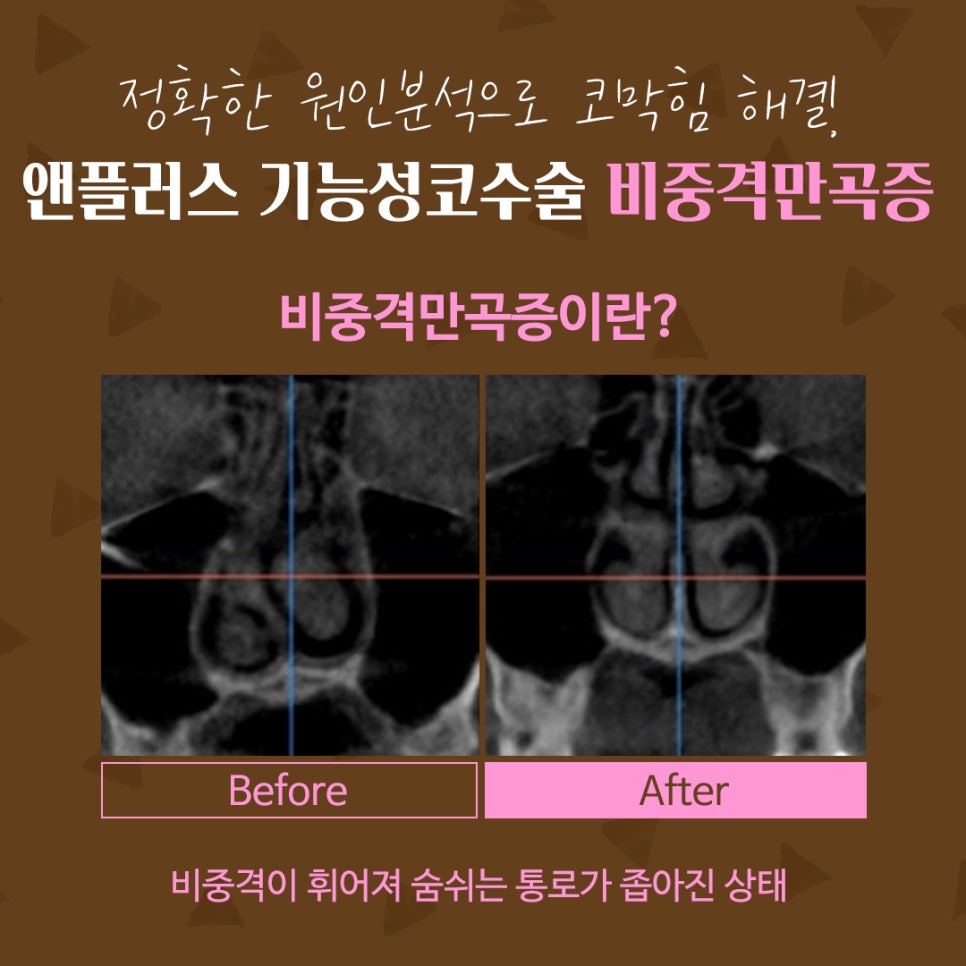 비중격만곡증수술후기 코막힘 고민 해결 관련 이미지 3