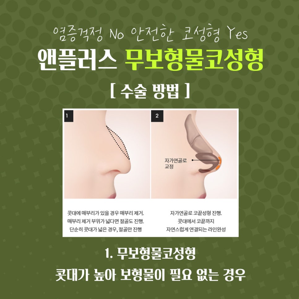 자가연골 활용한 코수술후기 관련 이미지 10
