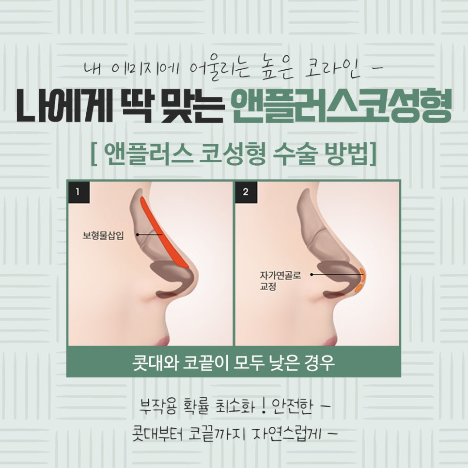 자가연골코수술로 세련되고 자연스럽게 관련 이미지 8