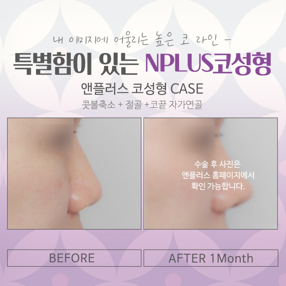 강남코수술에서 자연스럽고 예쁜 코라인! 관련 이미지 15