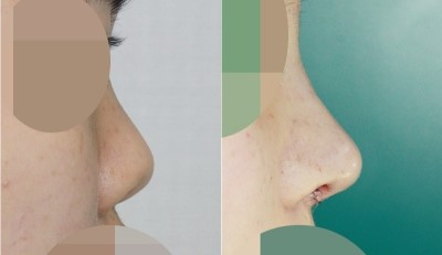 앤플러스 들창코성형 수술 전후 관련 이미지 1