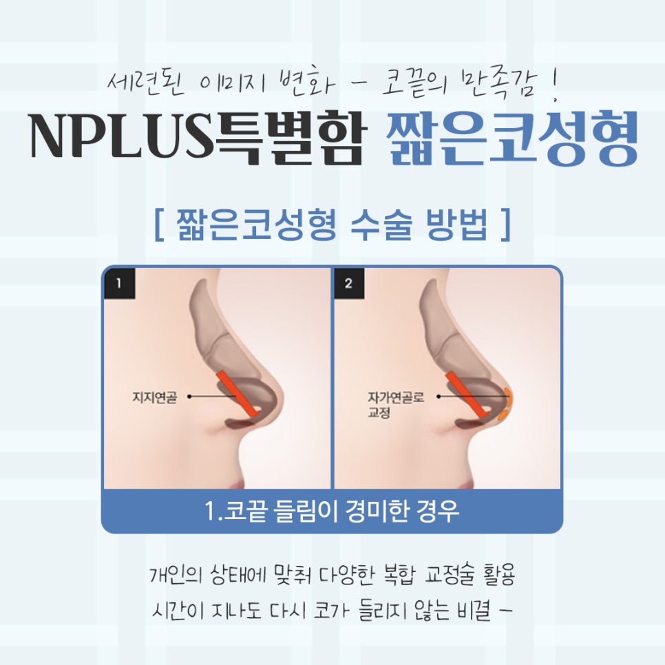 짧은코성형후기 자연스럽고 예쁘게 관련 이미지 8