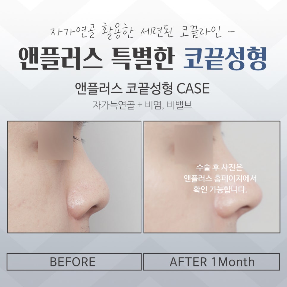 코끝수술후기에 대한 내용을 알아보고 관련 이미지 16
