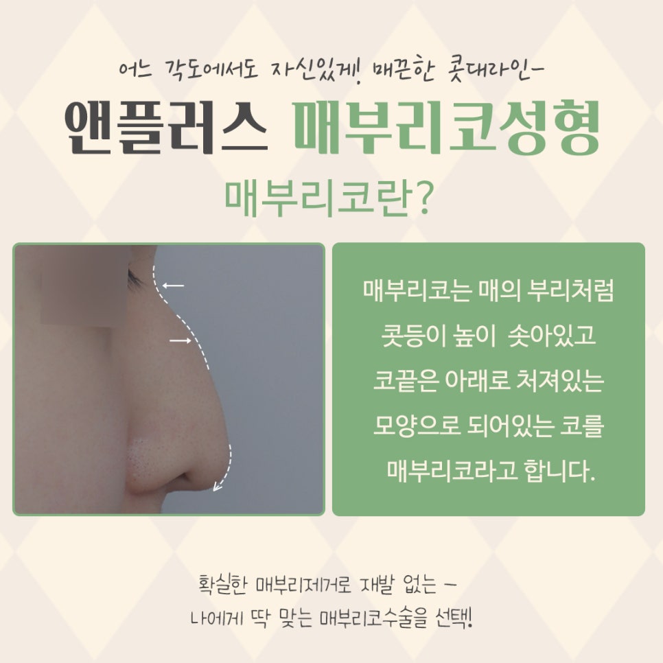 매부리코교정으로 달라진 전후를 확인하고 관련 이미지 4