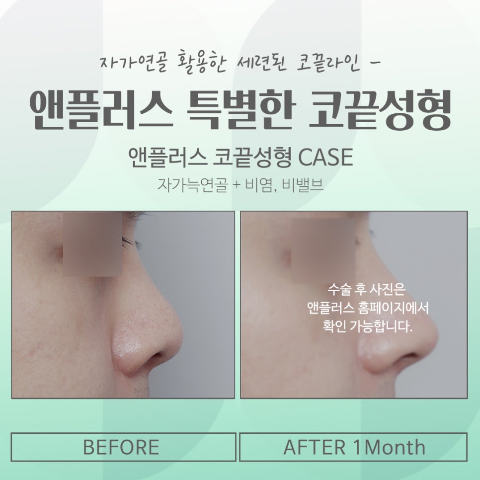 코끝성형후기를 확인하고 자연스럽게 교정하여 관련 이미지 16