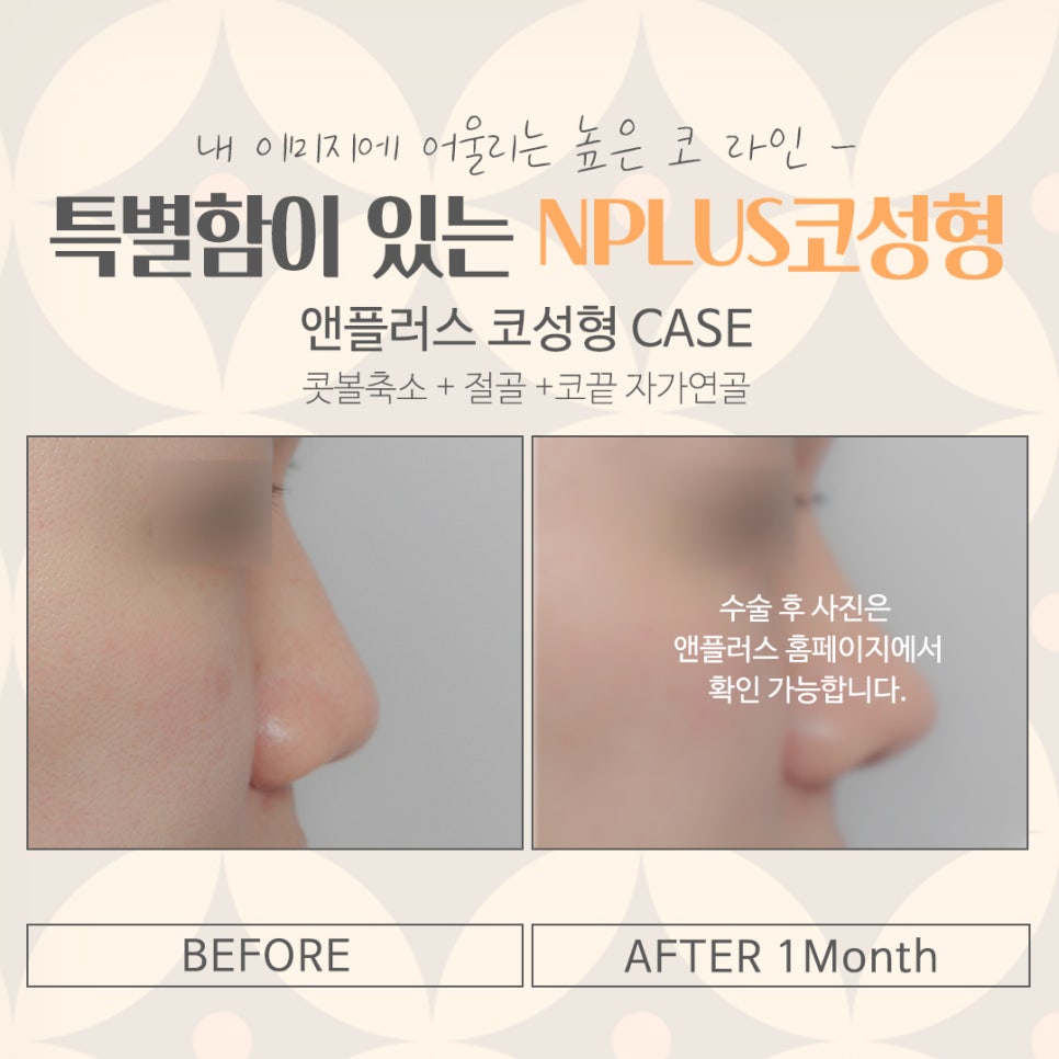 서울성형외과에서 알아본 코수술후기 관련 이미지 15