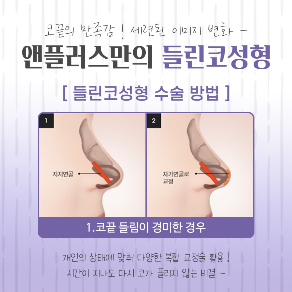 들린코성형 후기를 자세하게 알아보고 관련 이미지 9