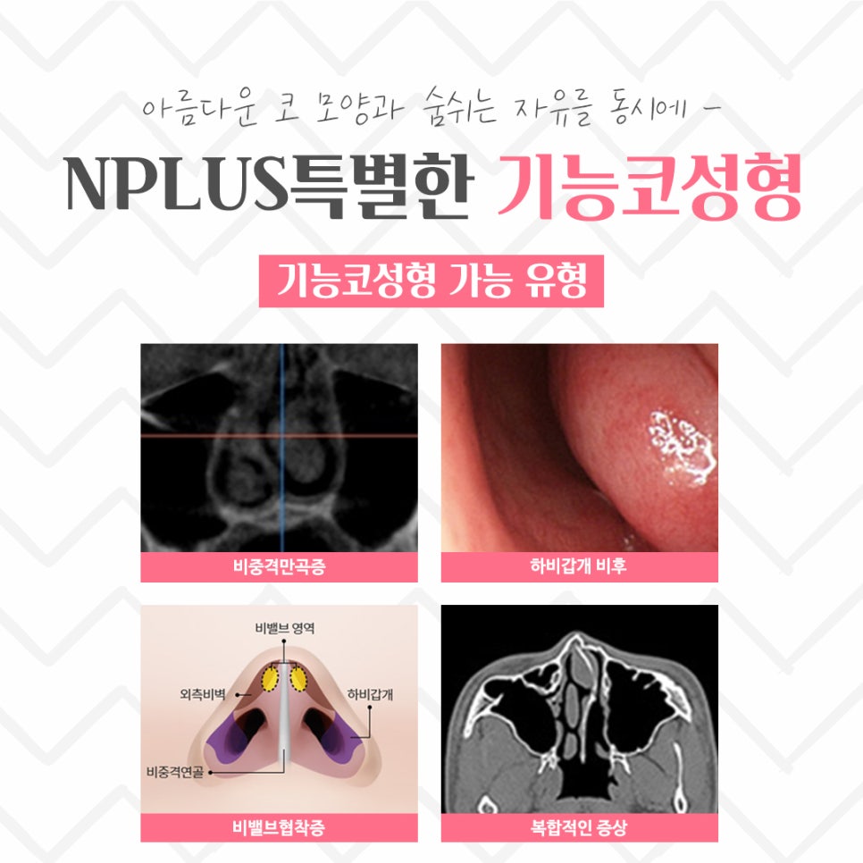 기능코성형후기 원인 파악을 확실하게 관련 이미지 5