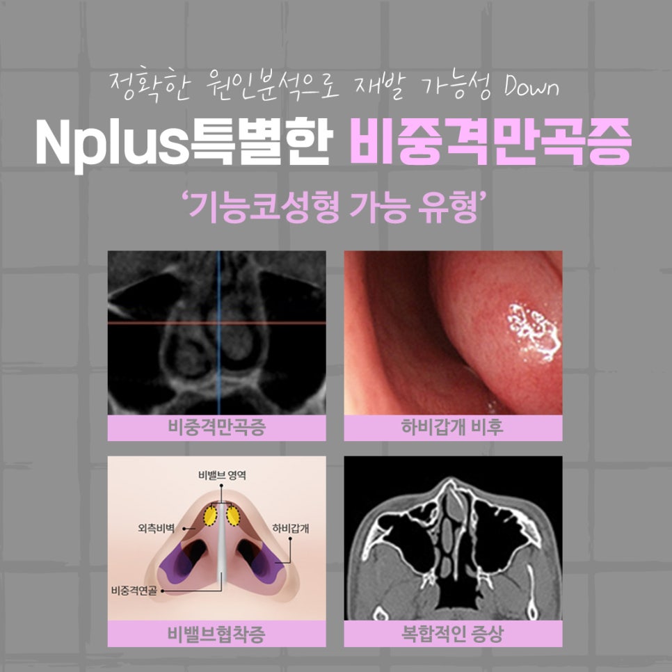 비중격만곡증수술 후기를 알아보고 결정 관련 이미지 4