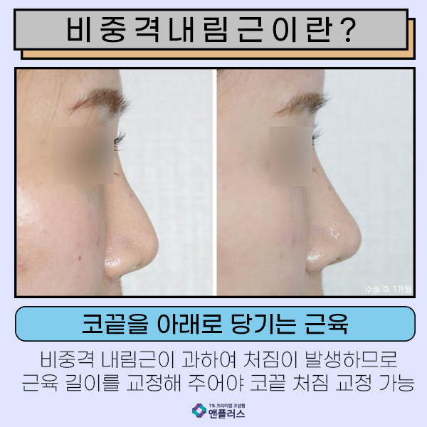 화살코성형 코끝이 고민일때 관련 이미지 3