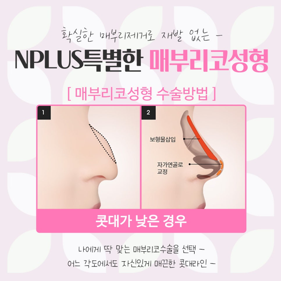 매부리코성형후기를 통해 이미지 개선 관련 이미지 10