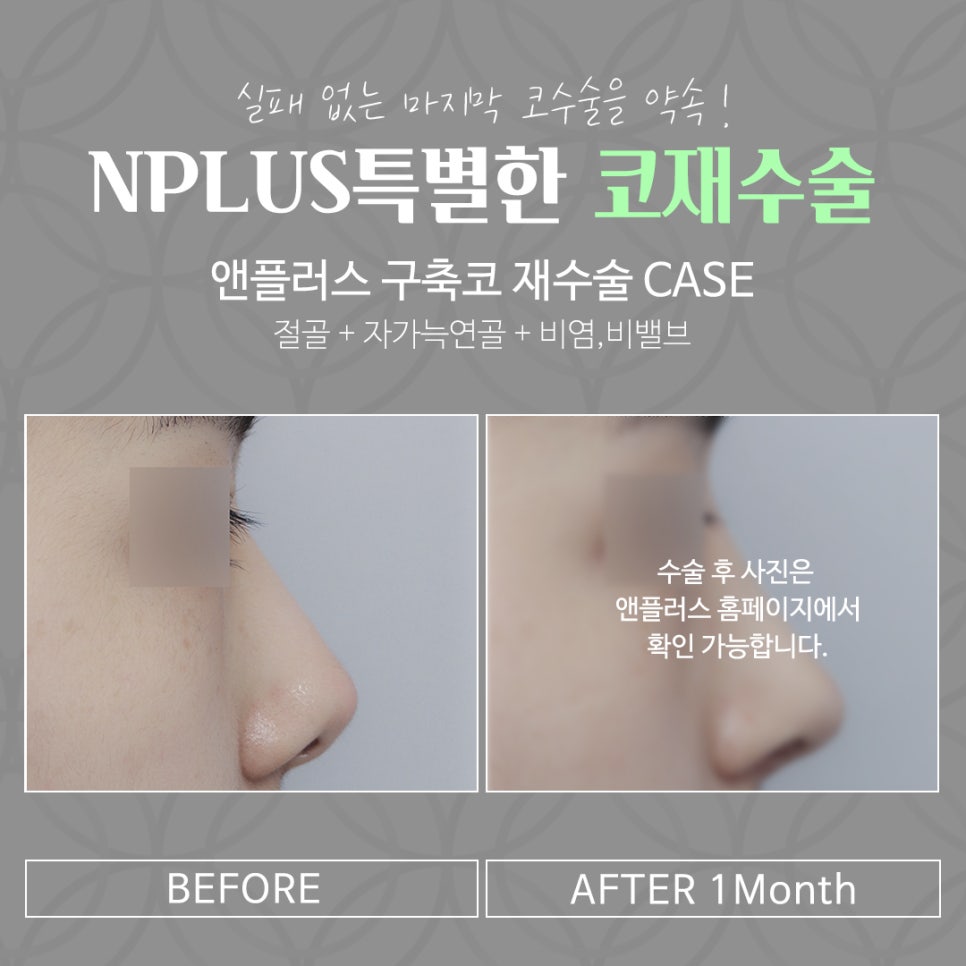 코재수술후기 확실하게 진단하여 관련 이미지 16