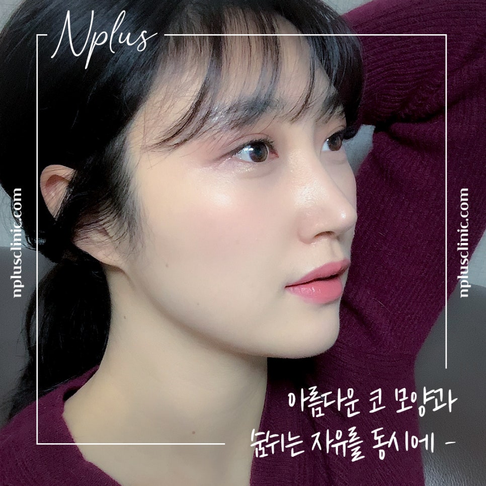 A Satisfying Result with One Rhinoplasty and Rhinitis Surgery image 1