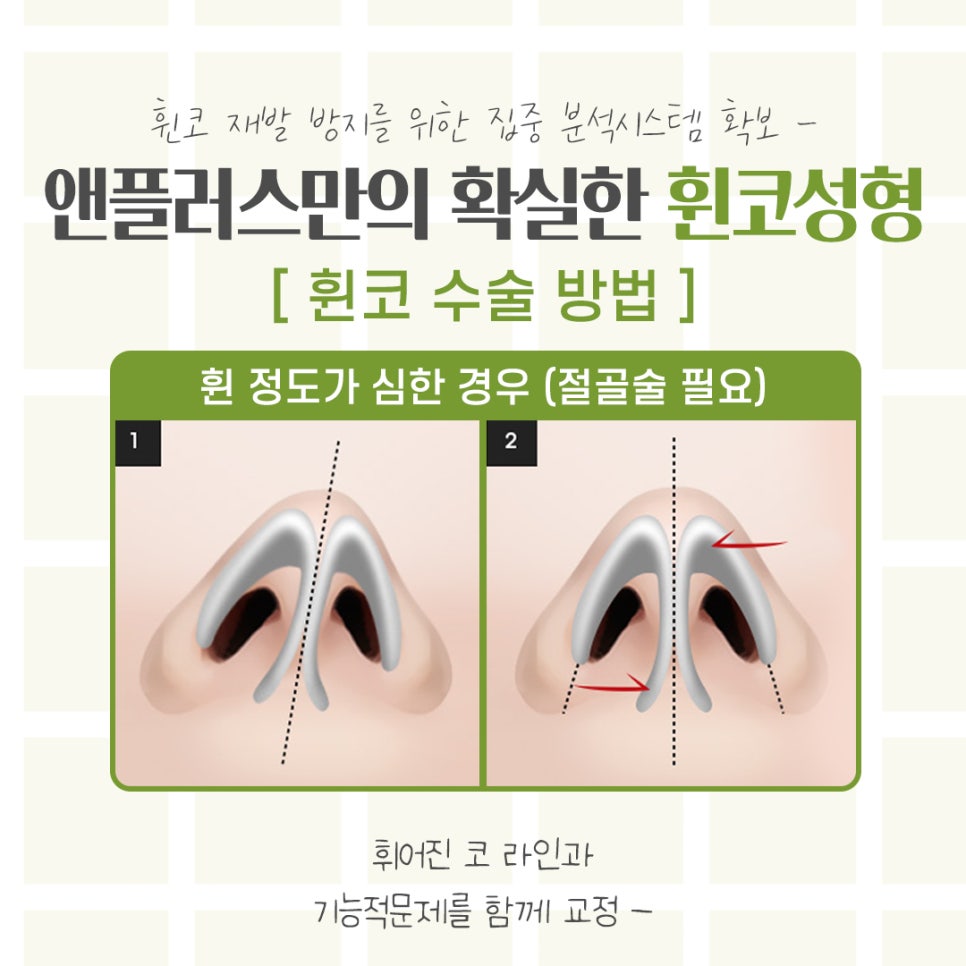 휜코수술에 대해 자세하게 확인하고 관련 이미지 9