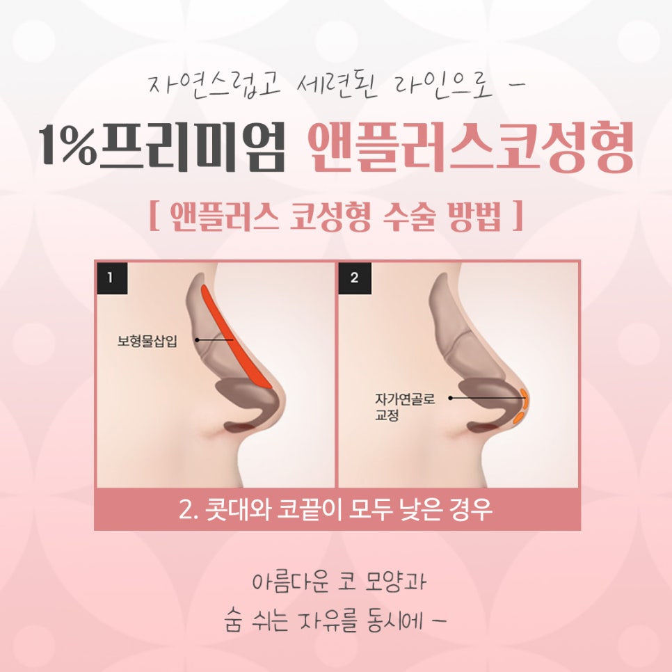 늑연골코수술을 통해 세련된 라인으로 관련 이미지 9