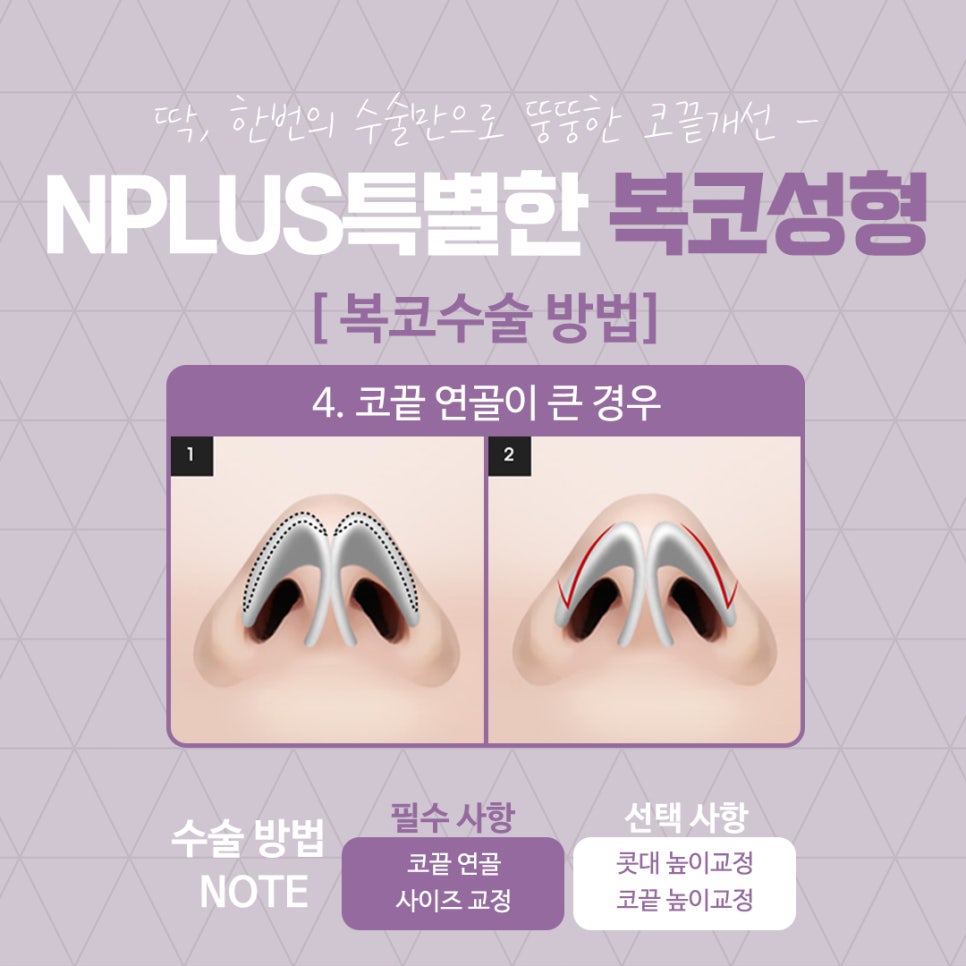 복코수술후기 슬림한 라인으로 관련 이미지 10