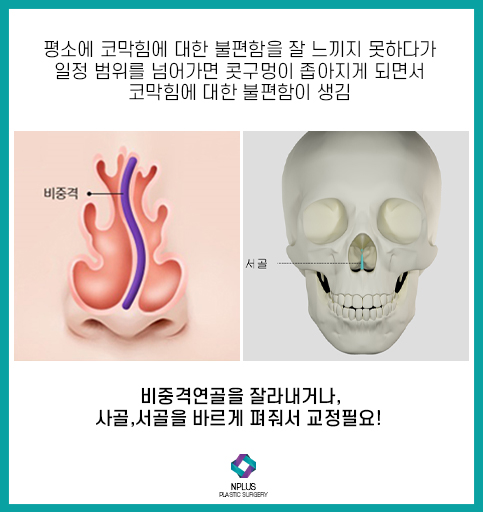 For Septoplasty Surgery, Experience Matters at the Hospital image 4