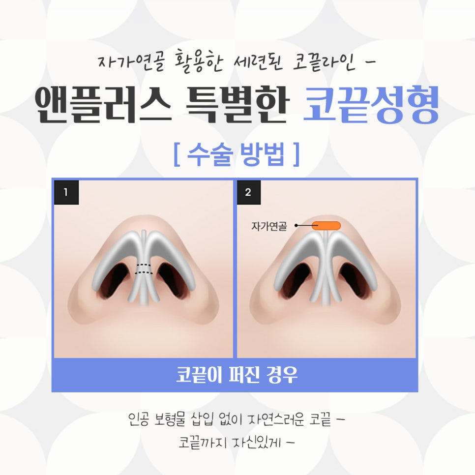 코끝수술에 대해 알아보고 신중하게 관련 이미지 10