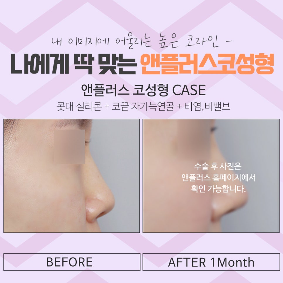 코수술후기 코 내부까지 확실하게 알아보고 관련 이미지 17