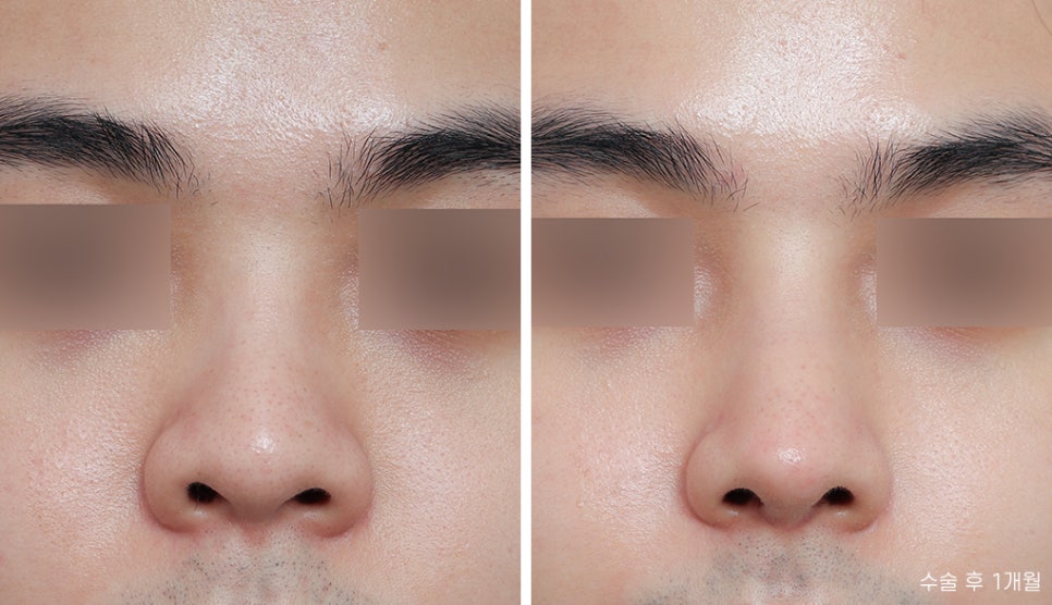 Natural and Satisfying Non-Implant Nose Surgery for Men image 3