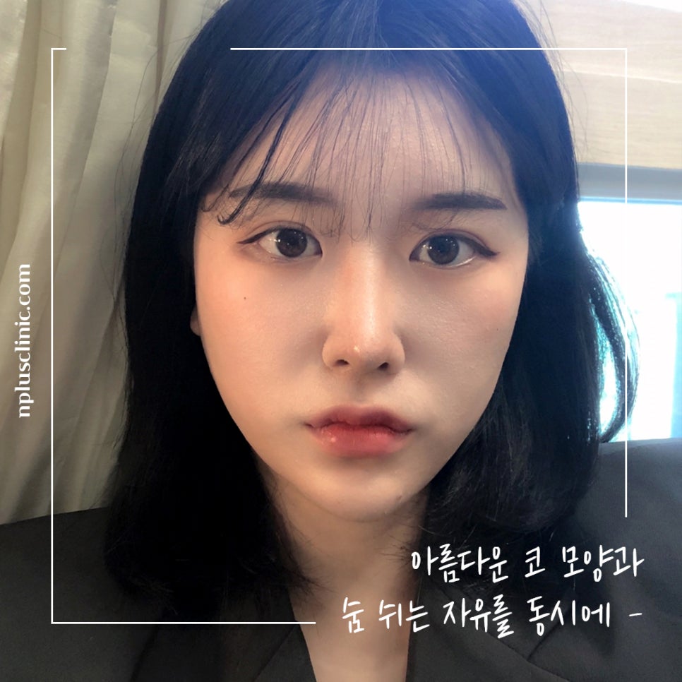 코수술전후 확실한 변화로 관련 이미지 3