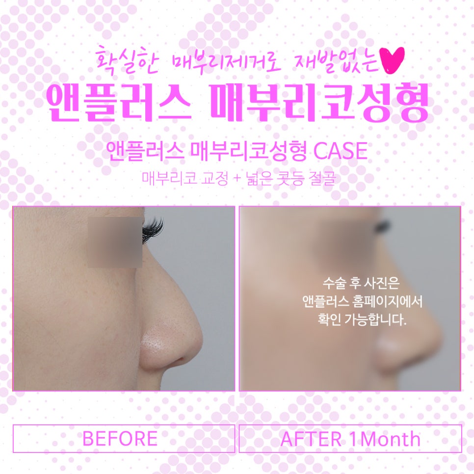 Women’s Hump Nose: The Hump Should Be Cleanly Removed image 4