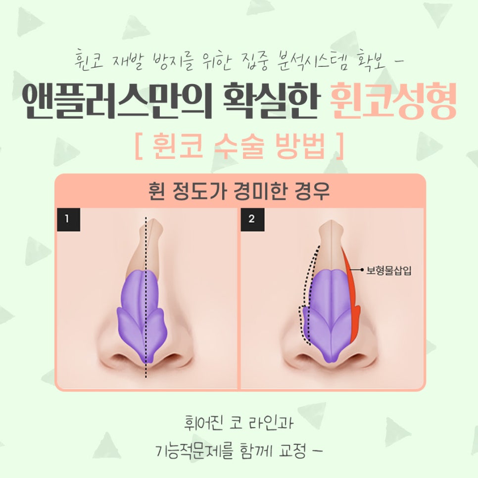 휜코성형후기 자세하게 알아보고 관련 이미지 9