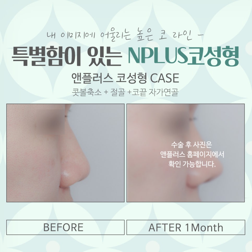 코수술잘하는곳 신중하게 선택 관련 이미지 14