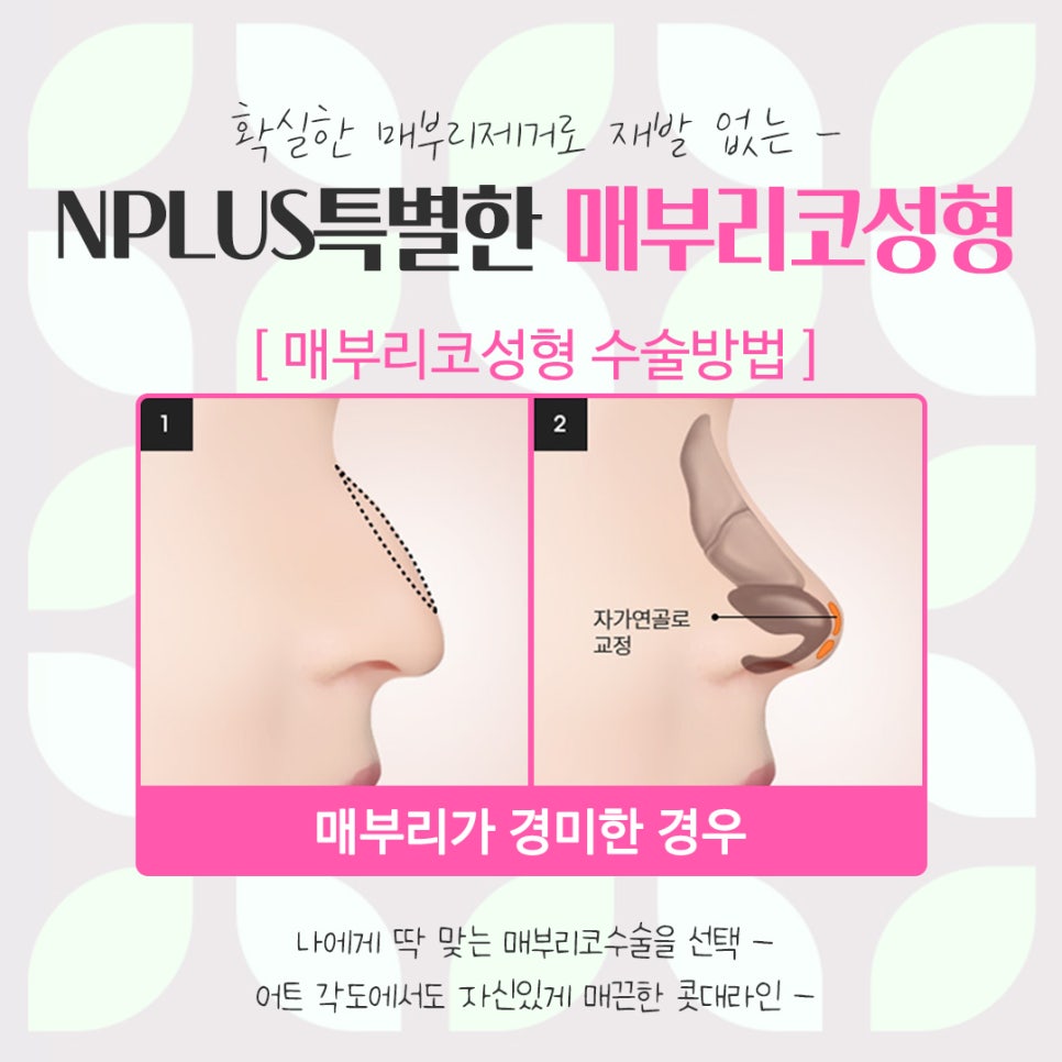 A Refined Look Through Female Hump Nose Surgery image 11