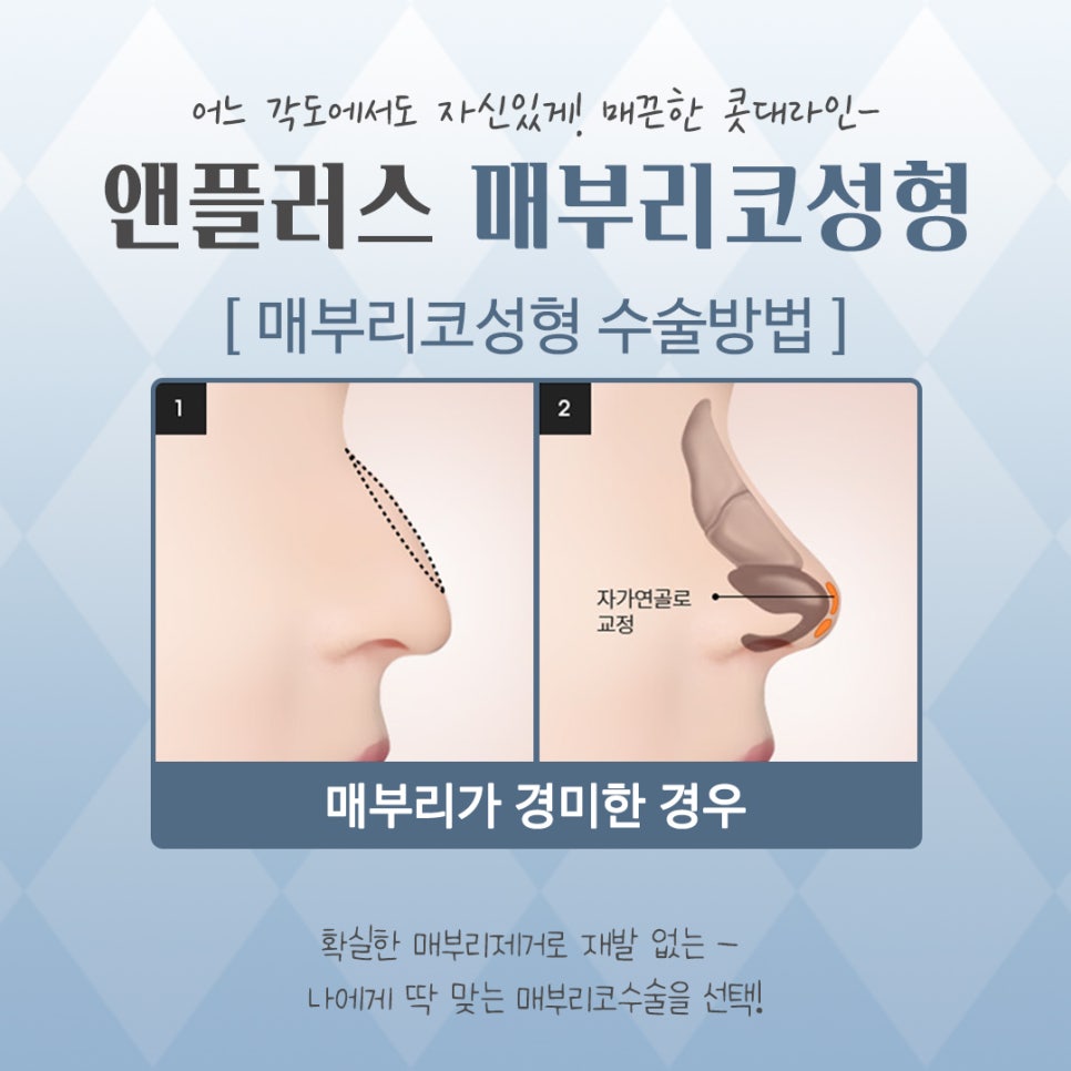 Looking into Cases of Before and After Hump Nose Surgery image 10