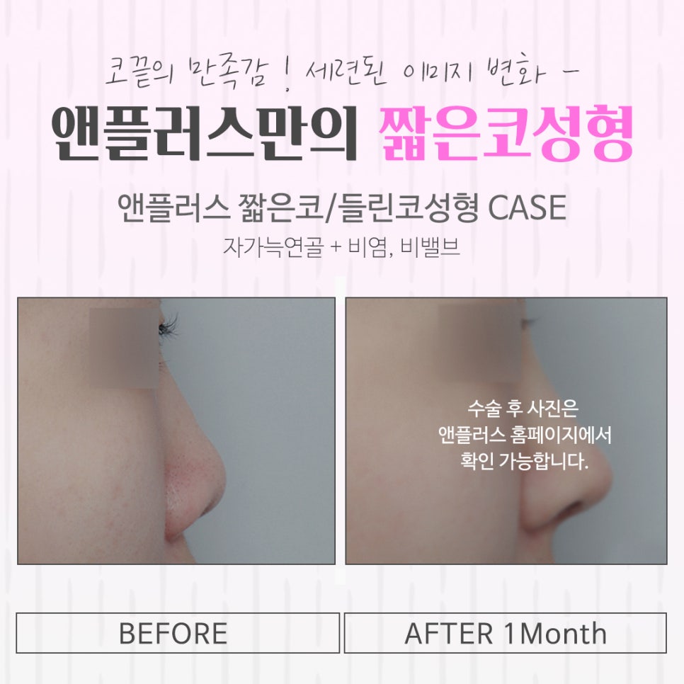 짧은코성형 정보를 정확하게 찾아보고 관련 이미지 8