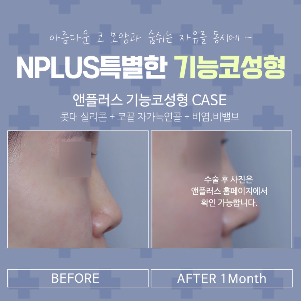 코수술보험 확실하게 알아보고 진행해야 관련 이미지 14