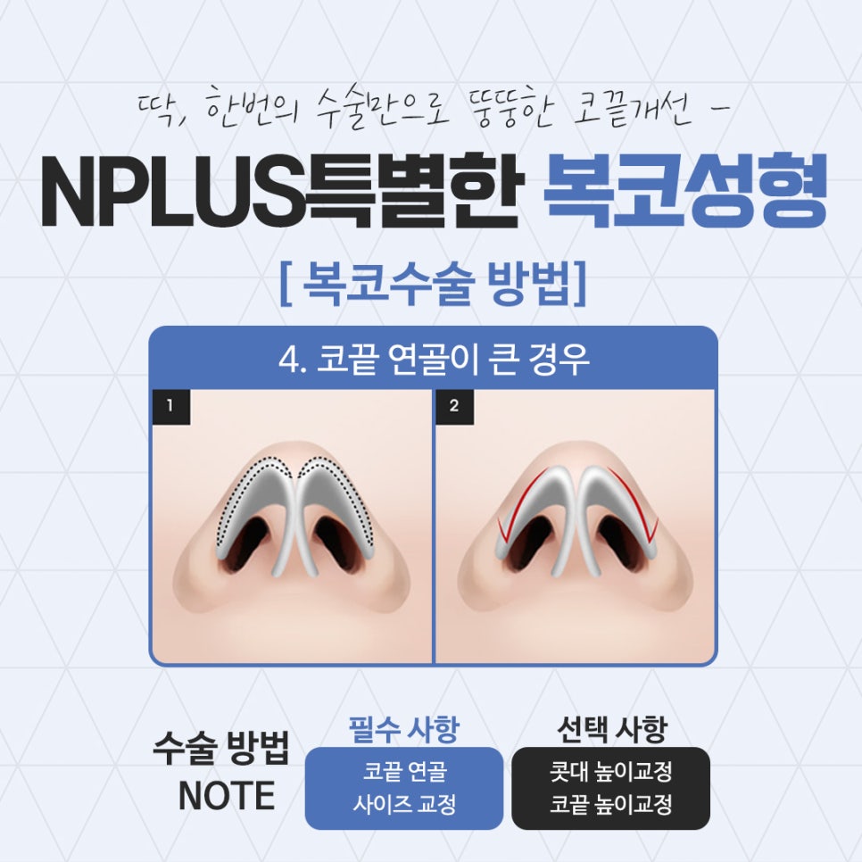Broad Nose Surgery Review for a Refined Look image 10