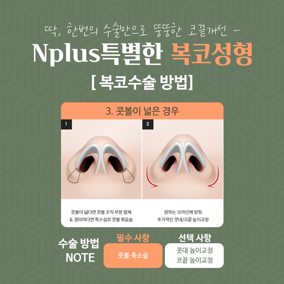 Rhinoplasty Review for a Bulbous Nose Through Nose Fat Removal image 8