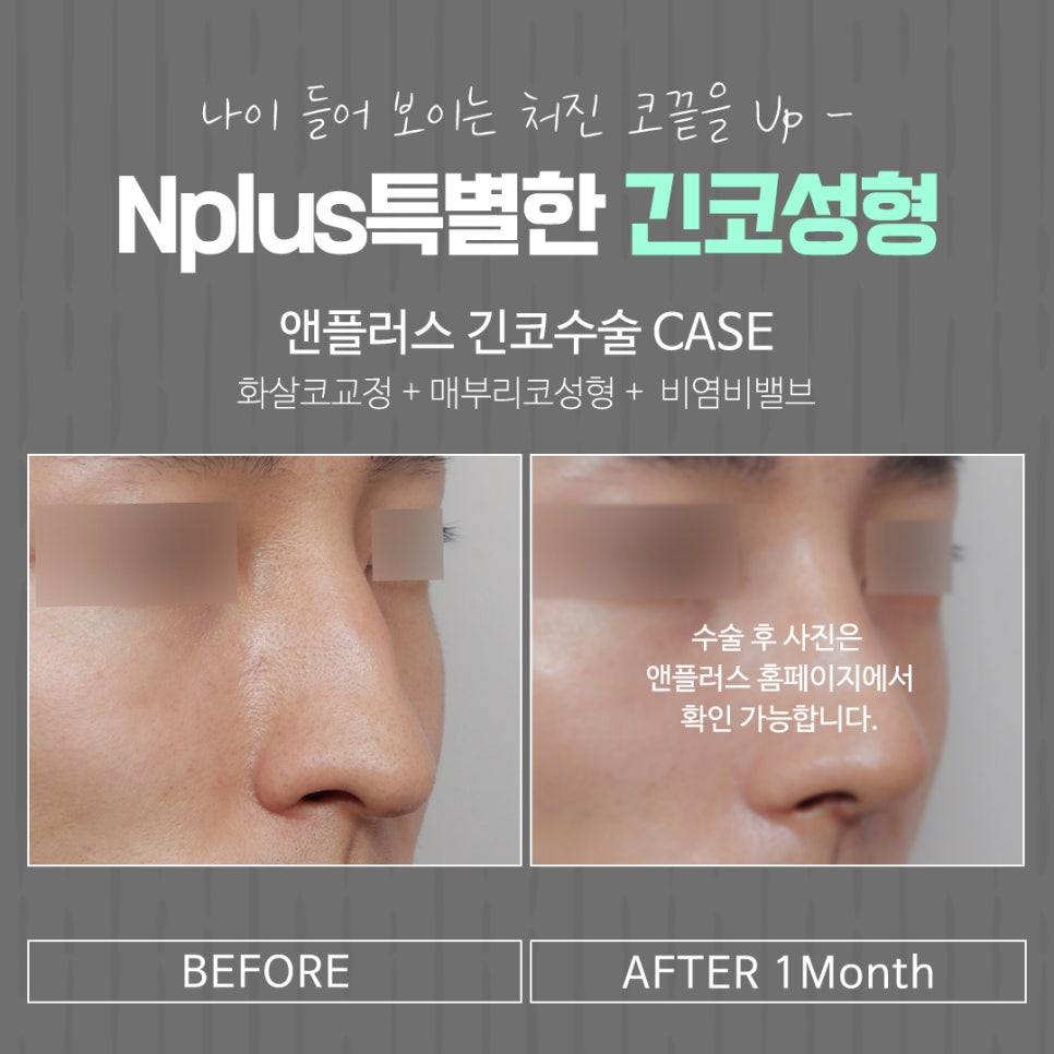 긴코수술 후기까지 확인하고 선택 관련 이미지 17