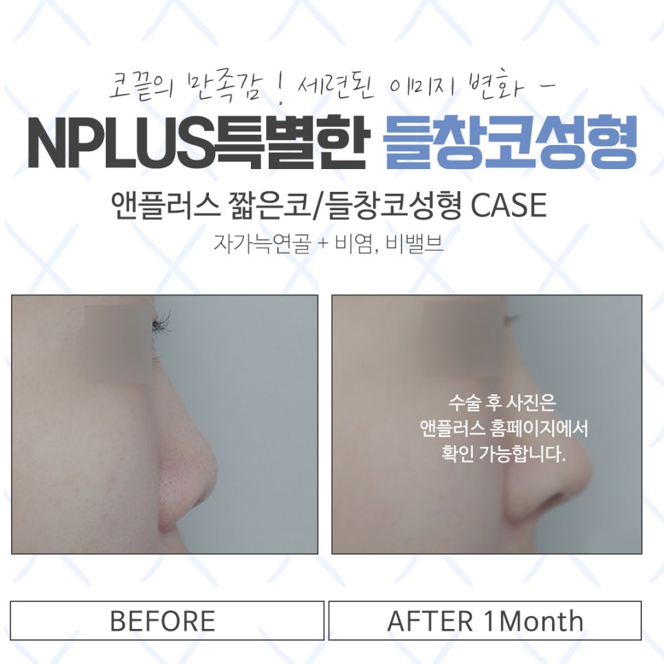 Upturned Nose Surgery for a Harmonious Look image 15
