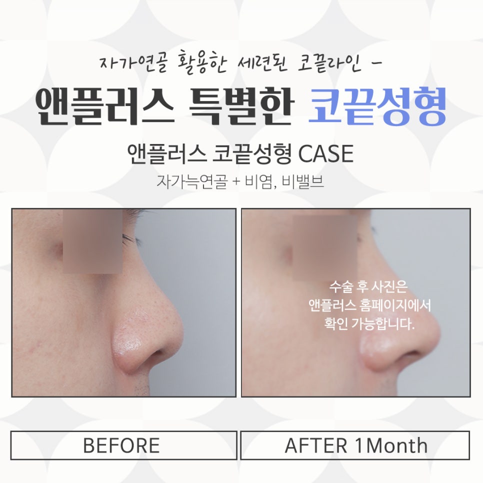 코끝수술에 대해 알아보고 신중하게 관련 이미지 6