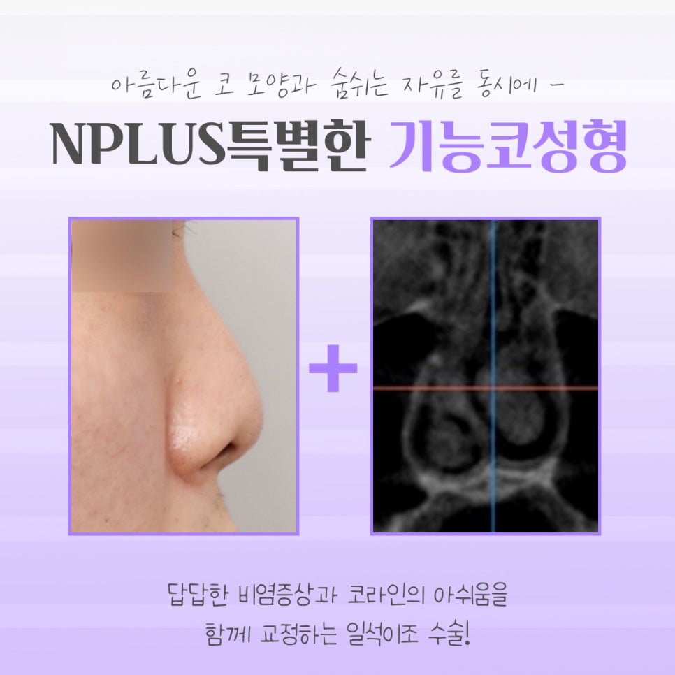 기능코성형후기에 대한 체크리스트 관련 이미지 4