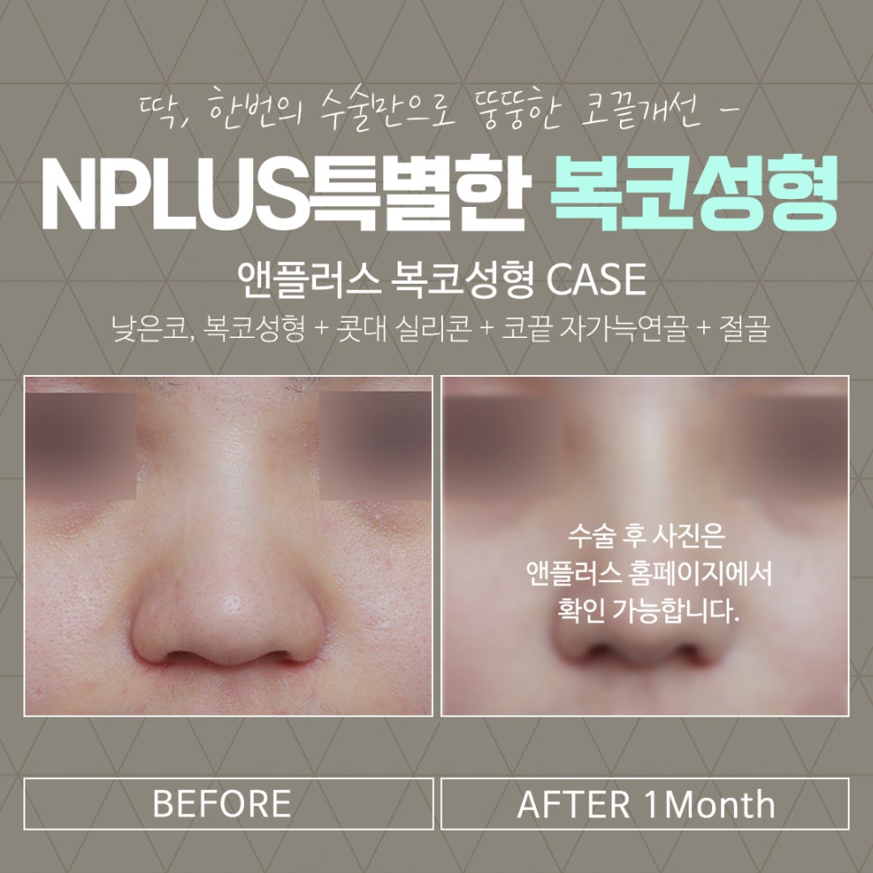 복코수술후기를  확인하고 세련된 이미지로 관련 이미지 16